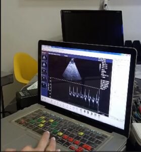 exame de ecocardiograma